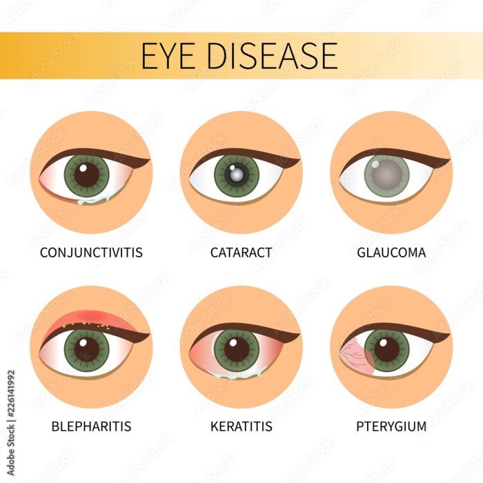 Diagnosing 8 Types of Eye Conditions