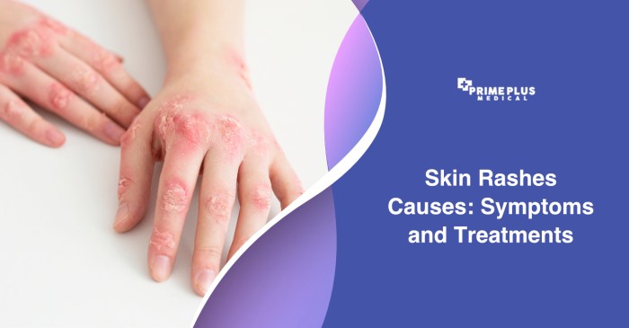 Remedies rashes rid effective