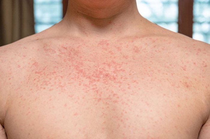 How to Diagnose 7 Skin Rashes at Home